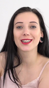 Video fetish della bocca con Bara che mostra l'apparecchio dentale.