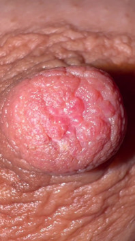 Nipple Montage