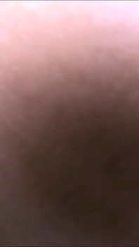 肛门铸造