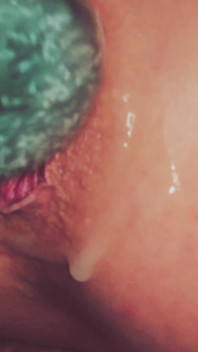 Dilatation Anal