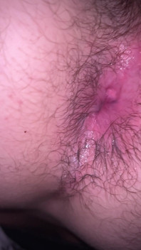 Bruised Asshole