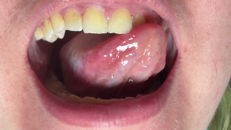 Spunk Kip: Mouth &amp; Tonsils Close-up