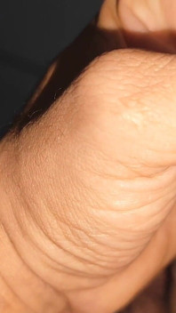 Extreme Application to the Syringe Inside the Glans!!