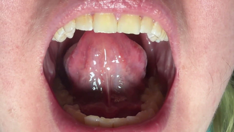 Spunk Kip: Mouth &amp; Tonsils Close-up