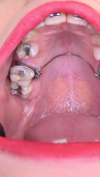 Video tôn sùng miệng với Bara cho thấy niềng răng.