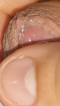 Curious Close-up of Pre-cum in Flaccid Phimosis.