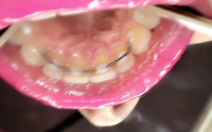 Princess18_: Permanent Retainers Mouth Tour