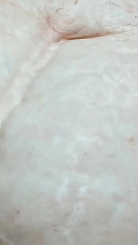 Sẹo sinh mổ 22 năm