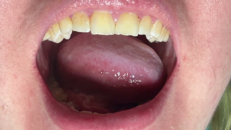 Spunk Kip: Mouth &amp; Tonsils Close-up