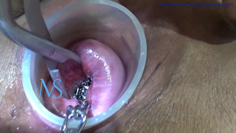 Maya Simons: Танец с цепочкой с пролапсом шейки матки