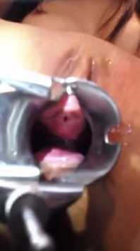 Speculum Cervix & Anal Exam Great View Inside