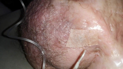 Monster_Meat_: 이중 주사의 2리터 포도당 '절반'