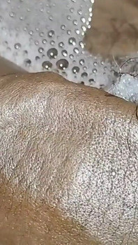 Thick Veins on Cms BBC