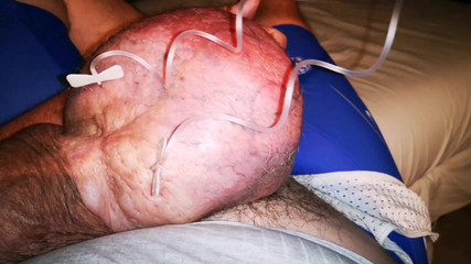 Monster_Meat_: Plnění 2 litry glukózy současně