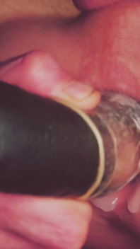 Dilatation Anal