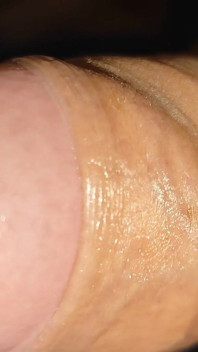 Difficult Fluid Control Due to Straight Phimosis.