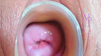 Maya Simons: Cervix dan Prolaps Midline