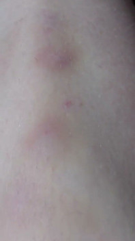 Te Muestro Los Moretones En Mis Piernas Después Del Sexo Duro