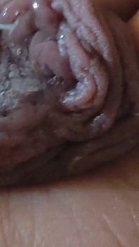 Enorme Phimosis Wordt Geëxtraheerd Sperma En Précum.