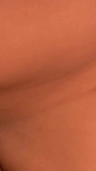 Rosebud prolapse anal esnetildikten sonra ıslak dışarı çıkıyor
