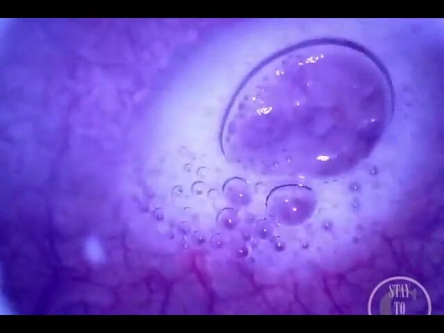 Lina Free: Pumpar luft in i hela urinblåsan med minikameran inuti