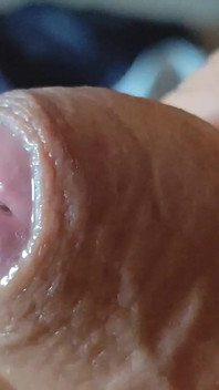 Deep Split in the Glans Produces Bubbling Liquid