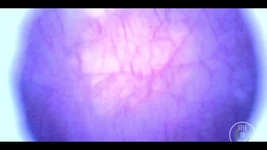 Magnifique à l’intérieur de ma vessie complète avec l’endoscope !