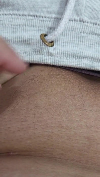 Die Haare auf meinem Penis – LED-Haarentfernung