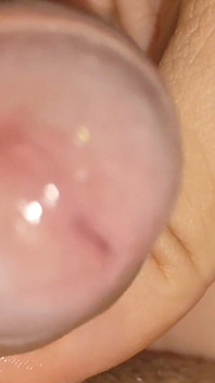 Large Cheese Accumulated in Close up of Glans