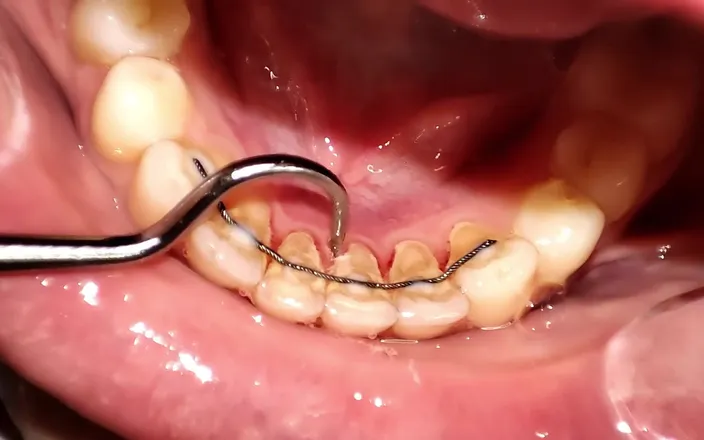 Princess18_: Dental Examination and Rough Cleaning with a Manual Scaler