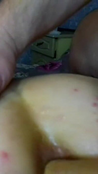Anello a dito anale