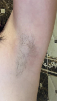 Epilazione di ascelle con un Epilatore! Si rasa le ascelle pelose! Depilazione!