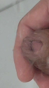 Strong Water in the Foreskin Excites the Glans Precum.
