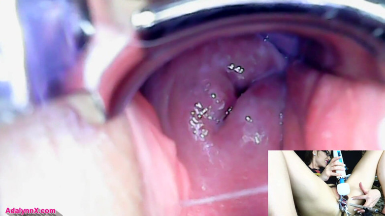 AdalynnX: Adalynnx - Endoscope, spéculum hitachi, vib