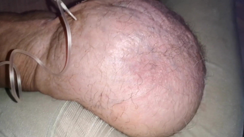 Monster_Meat_: Dwa litry glukozy wewnątrz mojego silikonu o pojemności 1380 cm3