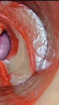Kompilasi creampie menetes cumfeti - tampilan endoscopy