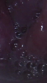 Inseminacja szyjki macicy