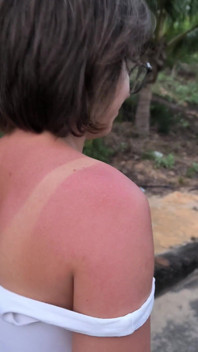 She Really Likes to Sunburn