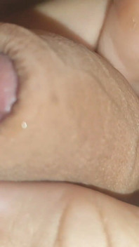Maximum Dilation of Phimosis Cumming.