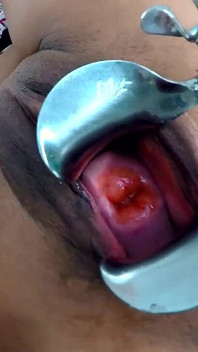 Exl-032: gand aur choot men vishaal vikshak. vishaal aage ko badhaav aur vishaal garbhashay griva. Full Extremelatina Scene Exl-032