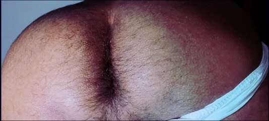 Rock F hairy: Mina skinkor