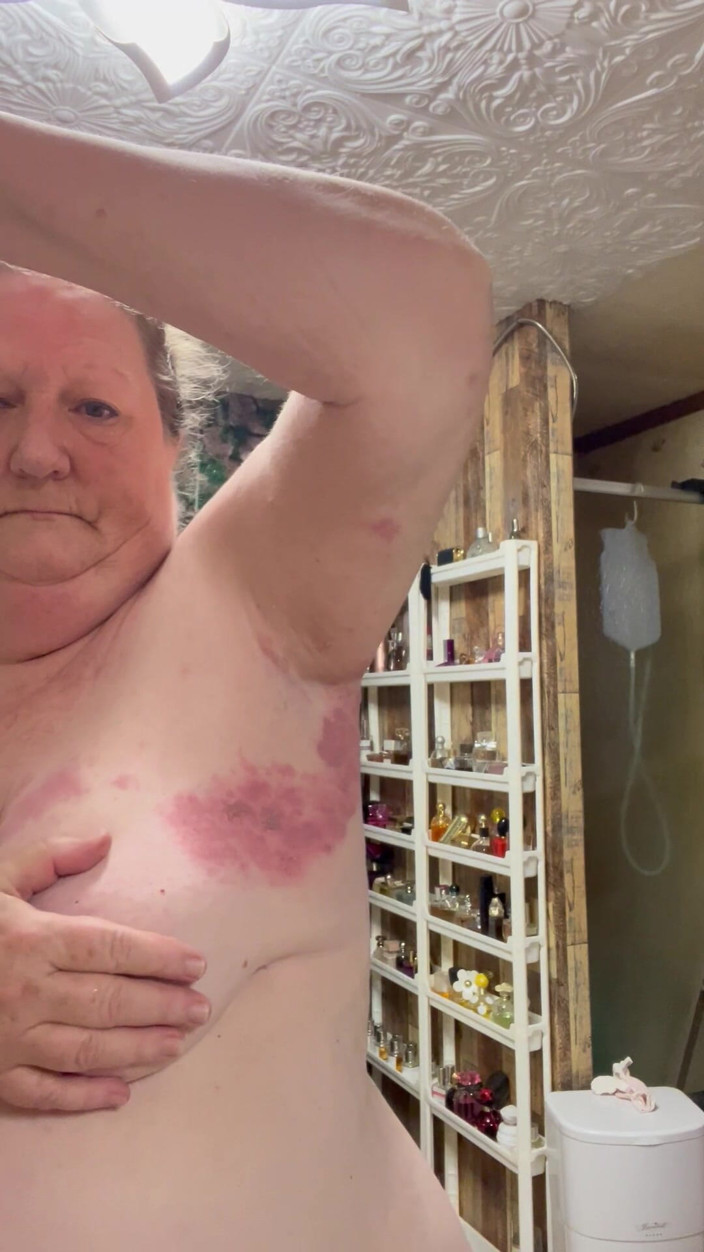 PlayfulRose1: Bad Case of Shingles