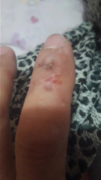 Mordida de dedo