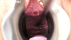 TripleXTransMan: 子宮頸部に挿入!