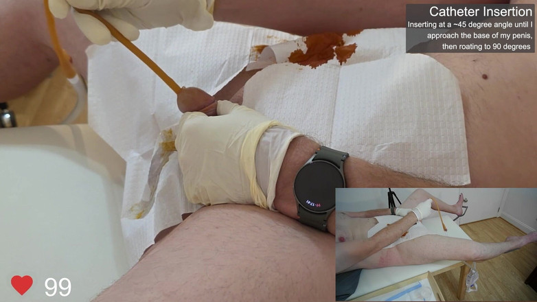 Clinical Climax: Insertion d’un cathéter