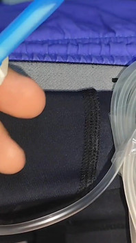 The Dick Had to Be Implanted Slowly.