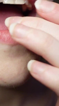 Te Cuento Sobre Los Rellenos En Mis Dientes Y Las Visitas Al Dentista