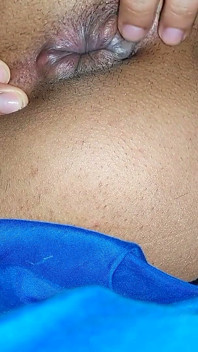 Hemorrhoids in the Ass