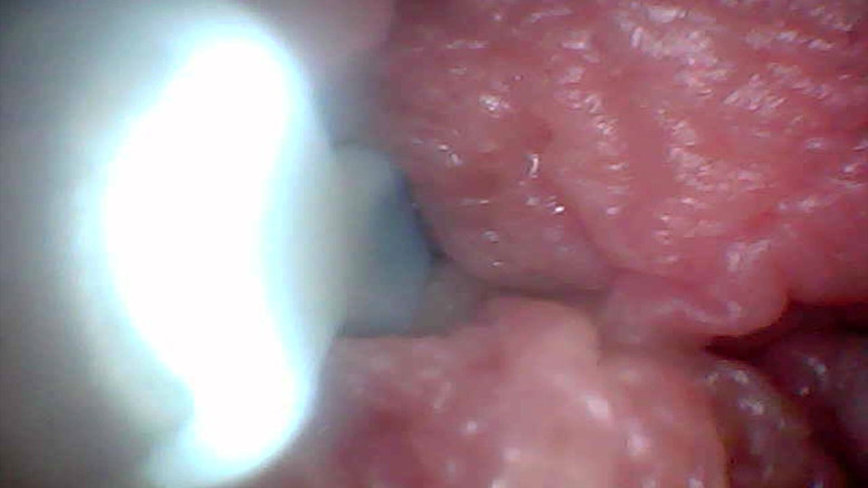 Twittiy: 内窥镜摄像头显示阴茎教育视频中最敏感的部分