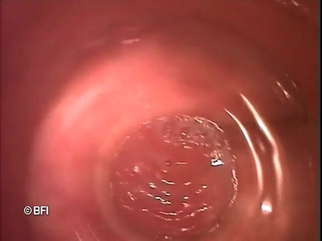 Pegging insertion: File bizzarri 163